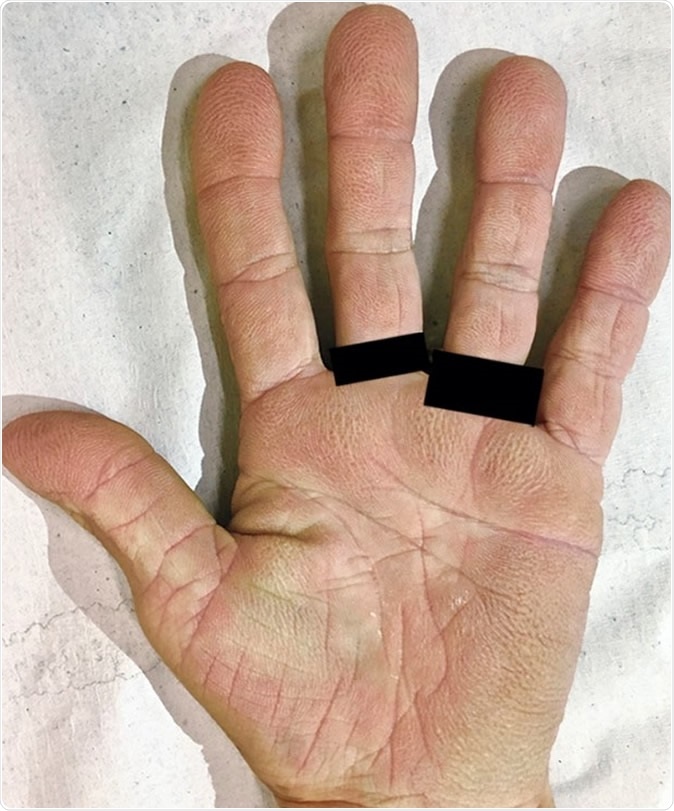 Velvety Palms, Denis Miyashiro, M.D., and Jose A. Sanches, M.D., Ph.D. Image Credit: The New England Journal of Medicine Publisher: Massachusetts Medical Society