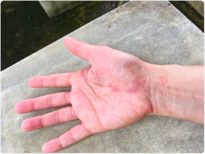 Sun exposure can lead to lupus flares. Involvement of the kidneys or/and the brain is the most serious manifestation of lupus. Lupus occurs ten times more often in women than in men. Image Credit: Korn Ratchaneekorn / Shutterstock