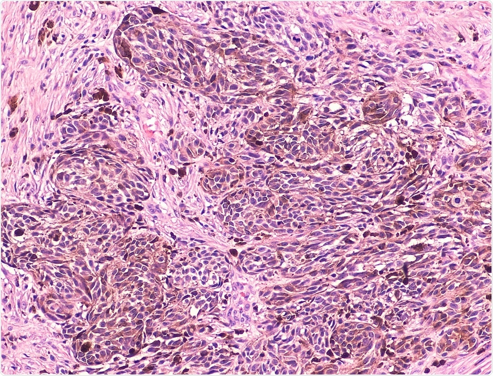 H&E stain of melanoma cells in skin
