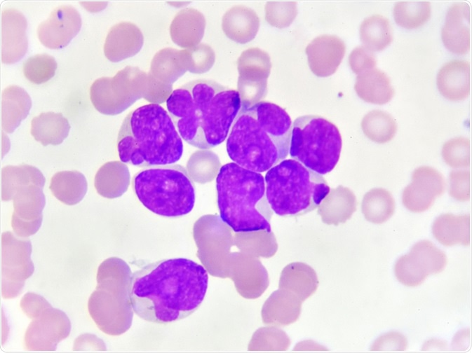 acute myeloid leukemia