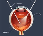 What is a Vitrectomy?