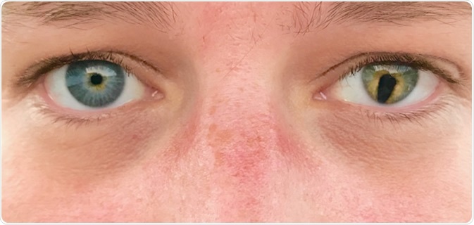 Coloboma is an eye abnormality that occurs before birth. Colobomas are missing pieces of tissue in structures that form the eye.