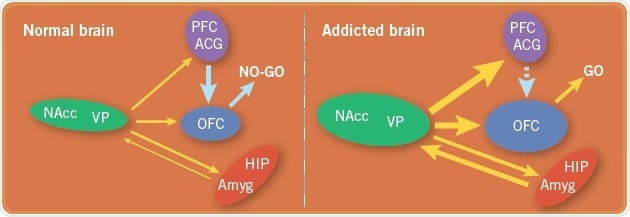 A comparison of the brain circuits in a normal brain with the brain circuits in an addicted brain