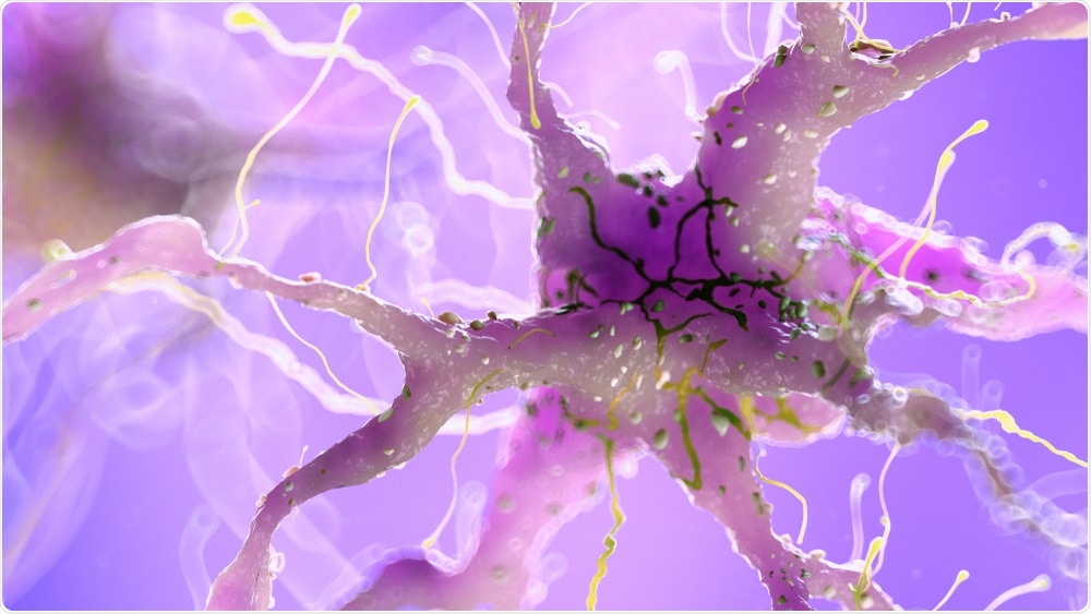 PET scans of the brain could be used to determine treatment plans for Alzheimer