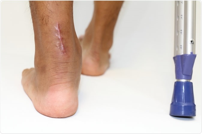 Operation scar for Achilles tendon. Image Credit: ziggy_mars  / Shutterstock