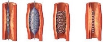 Insertion, balloon inflation, stent in position, in-stent restenosis (from left)