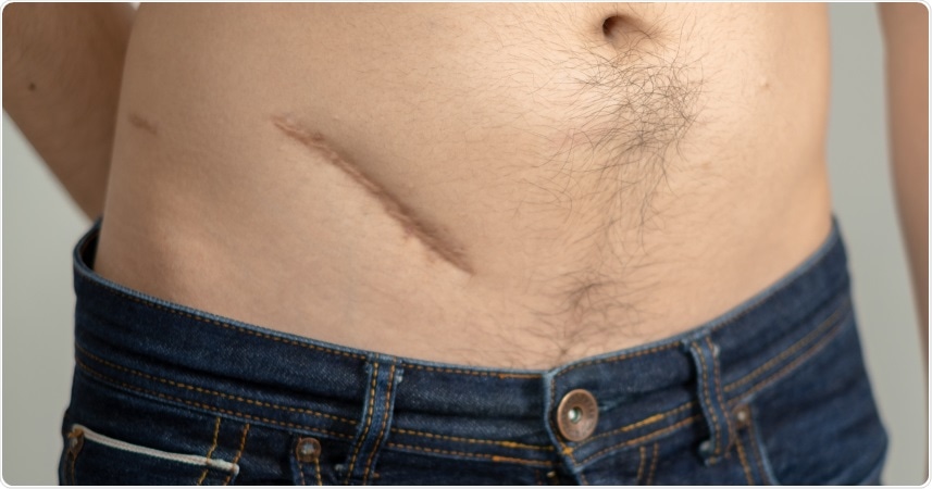 People who have had their appendix removed may be at an increased risk for developing Parkinson’s disease, according to findings due to be presented at this year’s Digestive Disease Week.