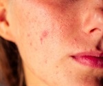 Acne in Women