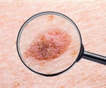 Higher melanoma rates linked to agricultural areas in Pennsylvania