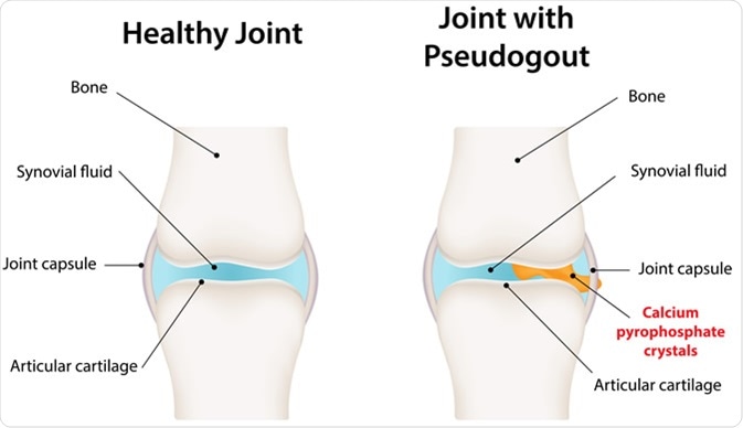 Pseudogout - image Credit: joshya / Shutterstock