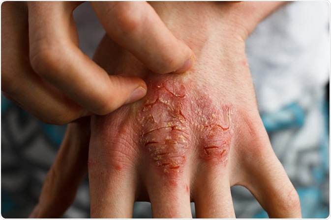 Dry flaky skin as a result of eczema. Image Credit: Ternavskaia Olga Alibec / Shutterstock