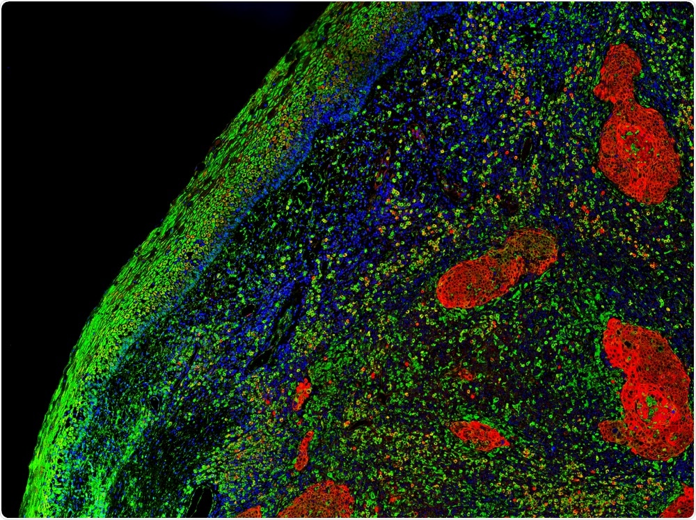 High resolution fluorescent microscope image of clusters of tumour cells in red surrounded by normal cells and normal skin in green.