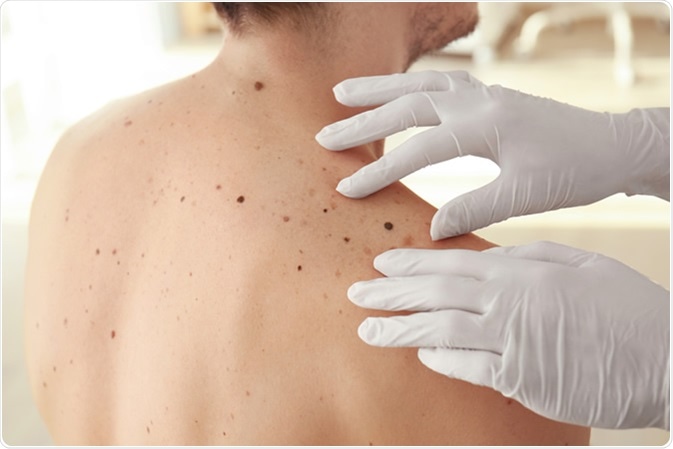 Dermatologist examining for potential melanomas. Image Credit: Africa Studio / Shutterstock