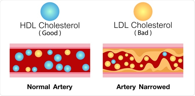 HDL cholesterol and LDL cholesterol in artery. Image Credit: Ching Design / Shutterstock