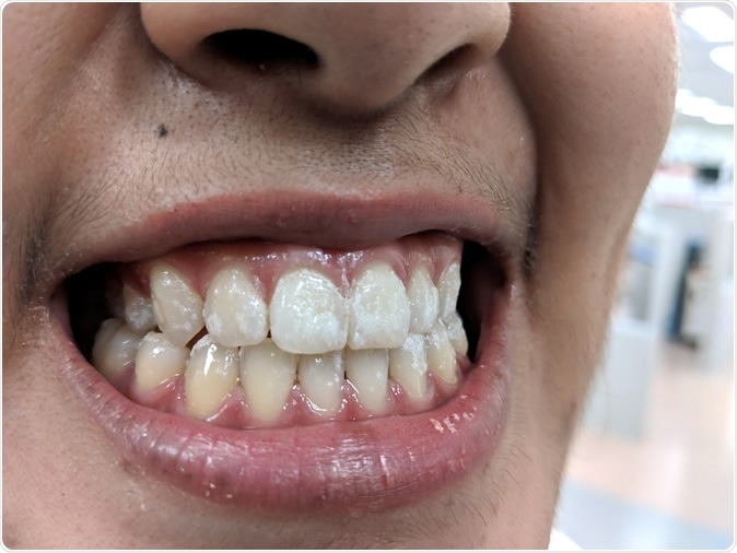 Teeth with fluoride varnish. Credit: Punrit Thongma-en/ Shutterstock