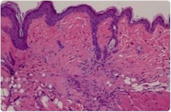 Failed cancer drug could potentially be used to treat fibrotic diseases and scleroderma