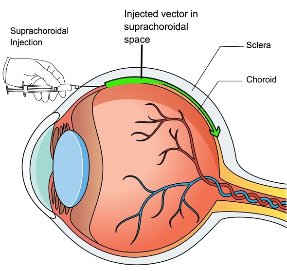 Johns Hopkins researchers develop new way to deliver sight-saving gene therapy to the retina