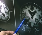 New insight and target for Alzheimer’s disease