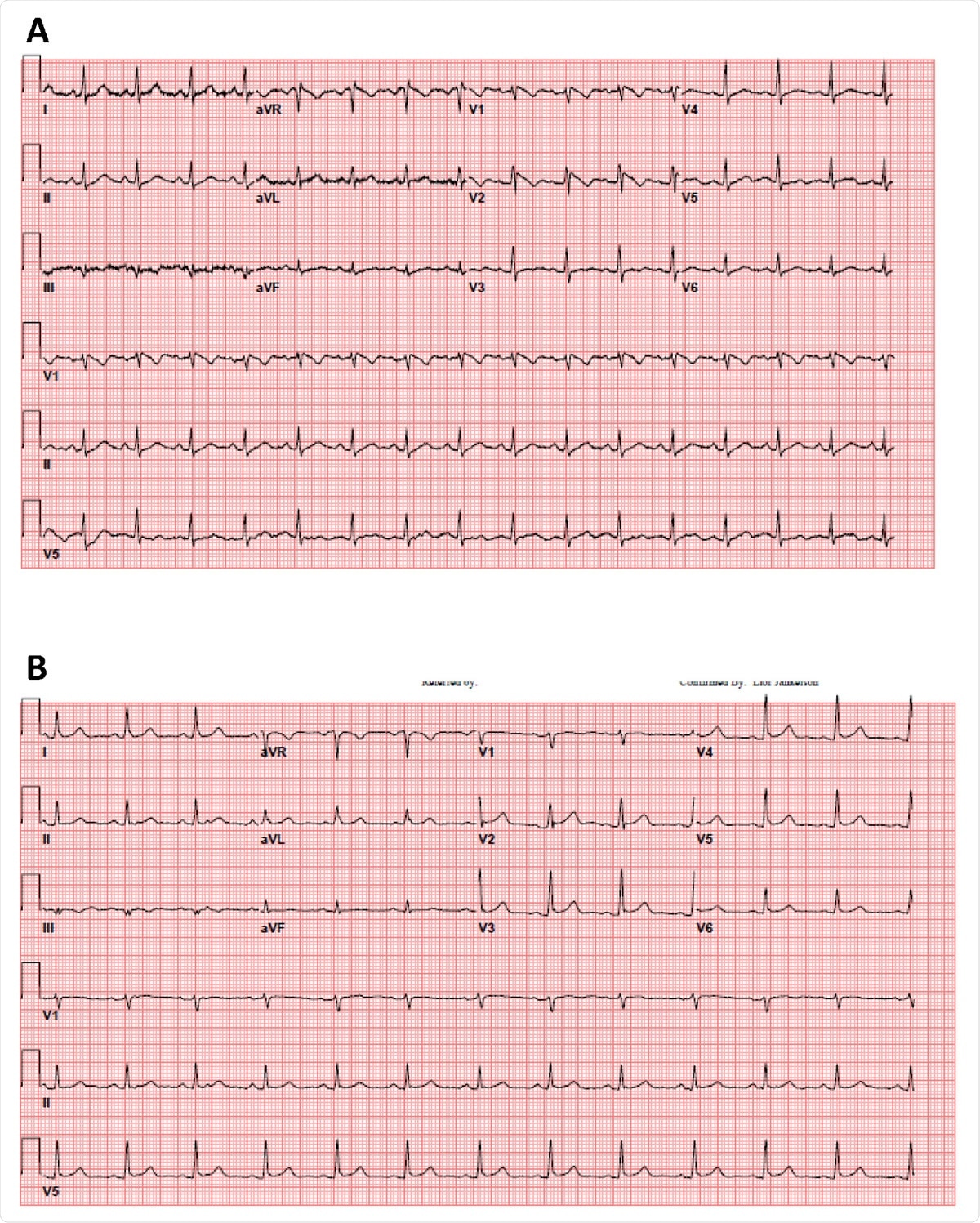 35 year old female patient without significant medical history presented with a fever of 103.1 F. A. The patient’s initial 12-lead electrocardiogram in the emergency department. B. The patient’s repeat 12-lead electrocardiogram with resolution of fever.