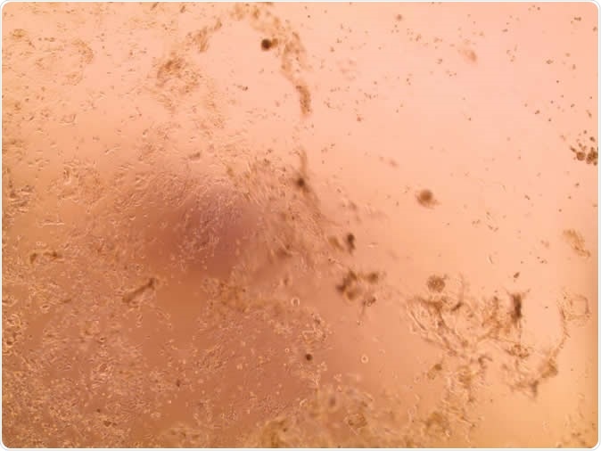 Institut Pasteur isolates strains of coronavirus 2019-nCoV detected in France. On the left, a cell layer not damaged by the viruses. On the right, a cell layer with a visible cytopathic effect (CPE); the cells infected by the virus have been destroyed. Image Credit: Institut Pasteur/CNR for Respiratory Viruses at the Institut Pasteur