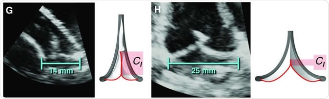 The valve replacement expanding to accommodate different lengths in implanted sheep. This material relates to a paper that appeared in the Feb. 19, 2020, issue of Science Translational Medicine, published by AAAS. The paper, by S.C. Hofferberth at Boston Children