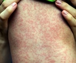 Measles re-emerging globally