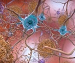 New Theory About Alzheimer's Disease