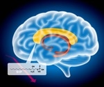 Schizophrenia related to abnormal fatty metabolism in the brain