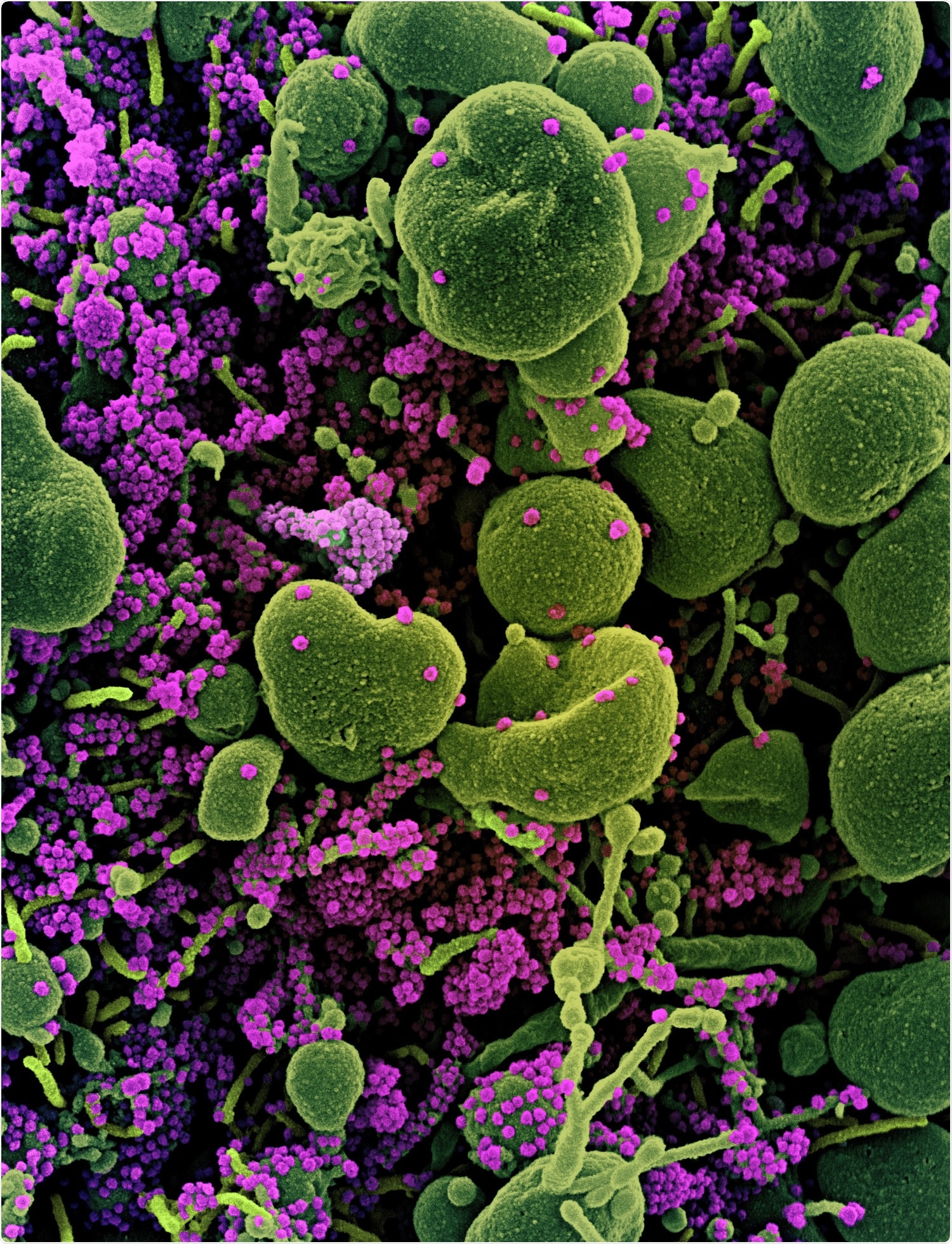 Novel Coronavirus SARS-CoV-2 Colorized scanning electron micrograph of an apoptotic cell (green) heavily infected with SARS-COV-2 virus particles (purple), isolated from a patient sample. Image captured at the NIAID Integrated Research Facility (IRF) in Fort Detrick, Maryland. Credit: NIAID