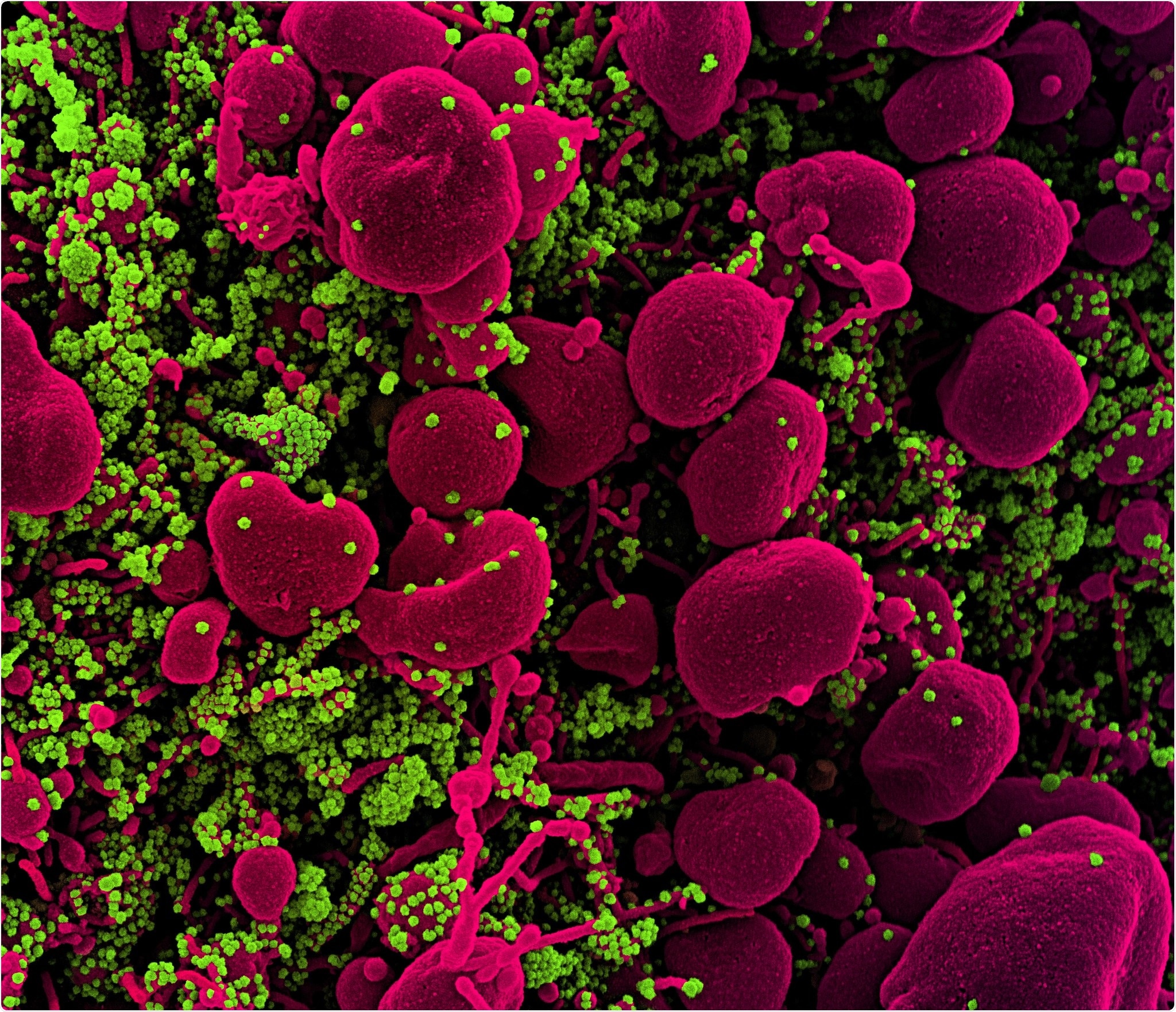 Novel Coronavirus SARS-CoV-2 Colorized scanning electron micrograph of an apoptotic cell (pink) heavily infected with SARS-COV-2 virus particles (green), isolated from a patient sample. Image captured at the NIAID Integrated Research Facility (IRF) in Fort Detrick, Maryland. Credit: NIAID