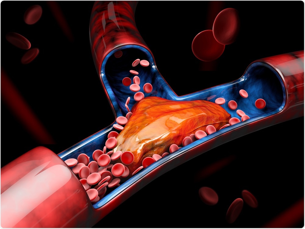 Study: High Incidence of Venous Thrombosis in Patients with Moderate to Severe COVID-19. Image Credit: Victor Josan