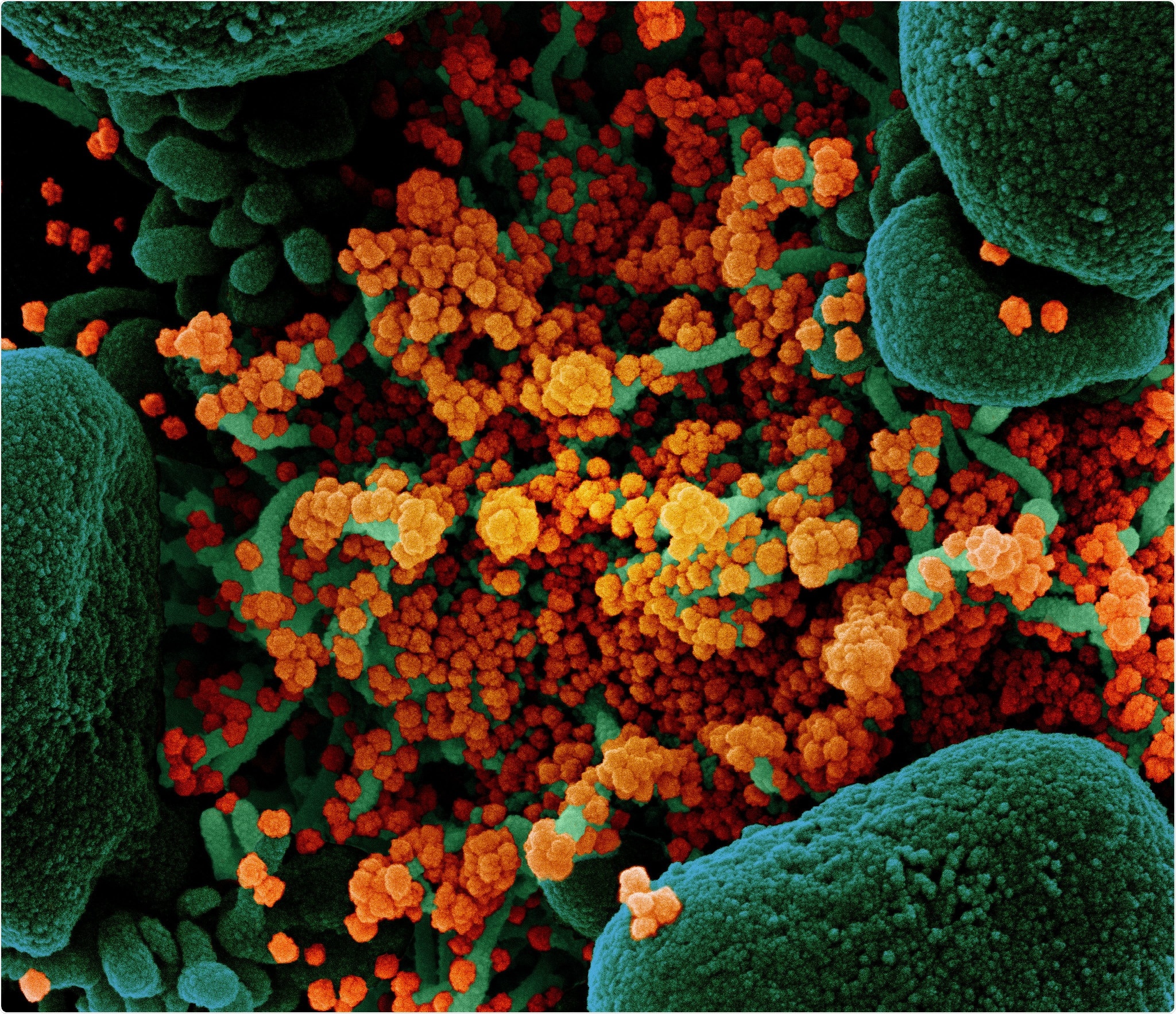 Novel Coronavirus SARS-CoV-2 Colorized scanning electron micrograph of an apoptotic cell (green) heavily infected with SARS-CoV-2 virus particles (orange), isolated from a patient sample. Image at the NIAID Integrated Research Facility (IRF) in Fort Detrick, Maryland. Credit: NIAID