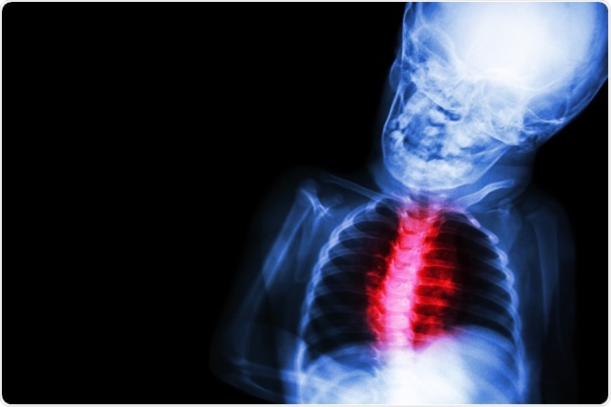 Congenital heart disease