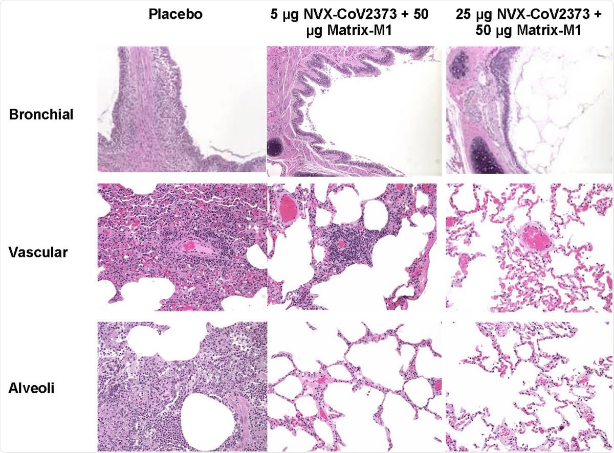 Representative histopathology of lungs from NVX-CoV2373 vaccinated cynomolgus macaques challenged with SARS-CoV-2 (WA1 strain). Histological findings of representative placebo treated animals included eosinophils expanding the mucosa of the bronchi, perivascular mononuclear infiltrate, with mixed macrophages and neutrophils within the alveoli at 7 days post infection. In the 5 μg dose group, one animal had mild to moderate perivascular infiltrate while other animals had no remarkable findings. There were no remarkable histological changes in the bronchial, vascular or alveoli in animals vaccinated with 50 μg NVX-CoV2373. There was no evidence of exacerbated lung inflammation in NVX-CoV2373 immunized animals.