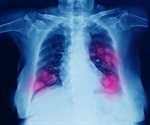 Metastatic Lung Cancer