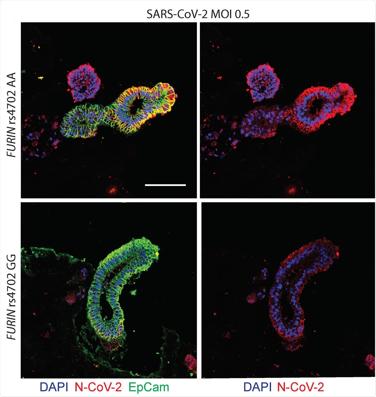 Allelic conversion at FURIN rs4702 in alveolospheres and neurons impacts SARS-CoV-2 infection. Representative immunofluorescence staining against SARS-CoV-2 nucleocapsid (N) protein (red), epithelial marker EPCAM (green), and DAPI (blue). Alveolospheres were generated from C2 FURIN rs4702 AA and GG lines and infected with mock or a MOI of 0.5 SARS-CoV-2 for 24 hours. Scale bar: 100 μm.