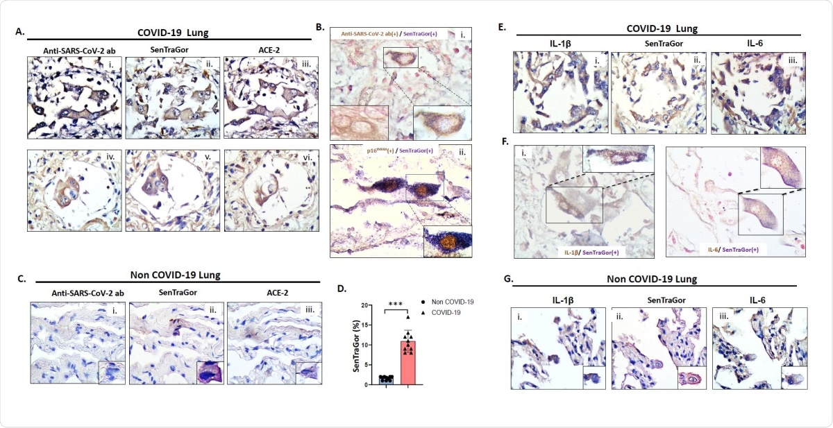 Representative images of G2 (i), SenTraGor (ii) and ACE-2 (iii) staining in serial sections of COVID-19 lung tissue. B. Representative results from double-staining experiments showing cytoplasmic localization of viral spike protein in cells that are concurrently positive with SenTraGor (senescent) (i), and nuclear p16INK4A expression in cells that are concurrently positive with SenTraGor (ii). B(i) left inset depicts an AT2 cell solely exhibiting cytoplasmic immunopositivity for the viral Spike protein. C. Representative images of G2 (i), SenTraGor (ii) and ACE-2 (iii) staining in serial sections of non COVID-19 “normal” lung parenchyma in the vicinity of a tumor (n=10, aged matched with cases presented in Fig 2A). Range of SenTraGor labeling indices: 1-2%. Morphologically, senescent AT2 cells in non COVID-19 tissue exhibit a decreased size in relation to those in COVID-19 cases. D. Graph depicting differences in SenTraGor staining between non-COVID19 and COVID19 cases, ***p<0.001 (Mann-Whitney U test). E. Representative images of Interleukin 1ß (IL-1ß) (i), SenTragor (ii) and Interleukin-6 (IL-6) (iii) in serial sections of COVID-19 lung tissue. F. Representative results from double-staining experiments showing cytoplasmic localization of IL-1ß in cells that are concurrently positive with SenTraGor (i), and IL-6 expression in cells that are concurrently positive with SenTraGor (ii). G. Representative images of IL-1ß (i), SenTraGor (ii) and IL-6 (iii) in serial sections of non-COVID-19 lung tissue (see also C). Original magnification: 400x, Insets 630x; Hematoxylin and nuclear fast red counterstain (Bi and F); DAB IHC – brown color; In co-staining SenTraGor was visualized with the BCIP/NBT chromogenic hybrid Histo-IHC reaction (dark blue perinuclear and cytoplasmic colour).