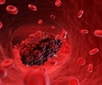 Fibrin immunotherapy may resolve blood clotting induced by SARS-CoV-2