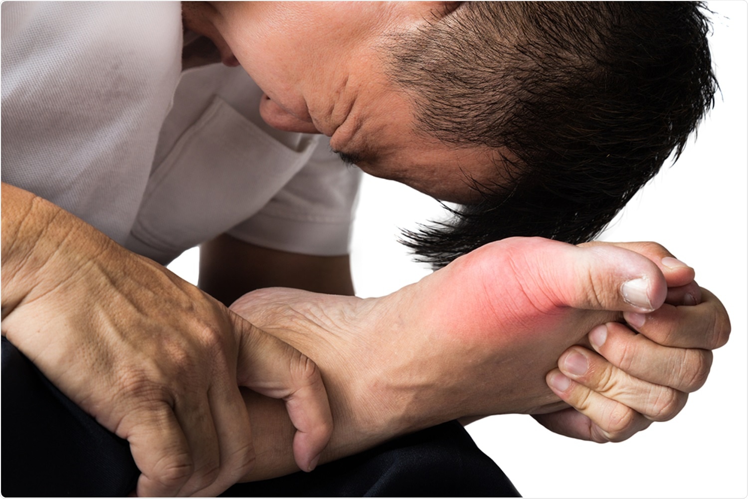 Study: Gout and coronavirus disease-19 (COVID-19): the risk of diagnosis and death in the UK Biobank. Image Credit: ThamKC / Shutterstock
