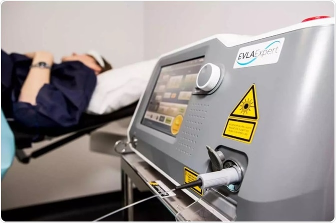 Endovenous laser ablation can be used to treat the underlying conditions to varicose veins