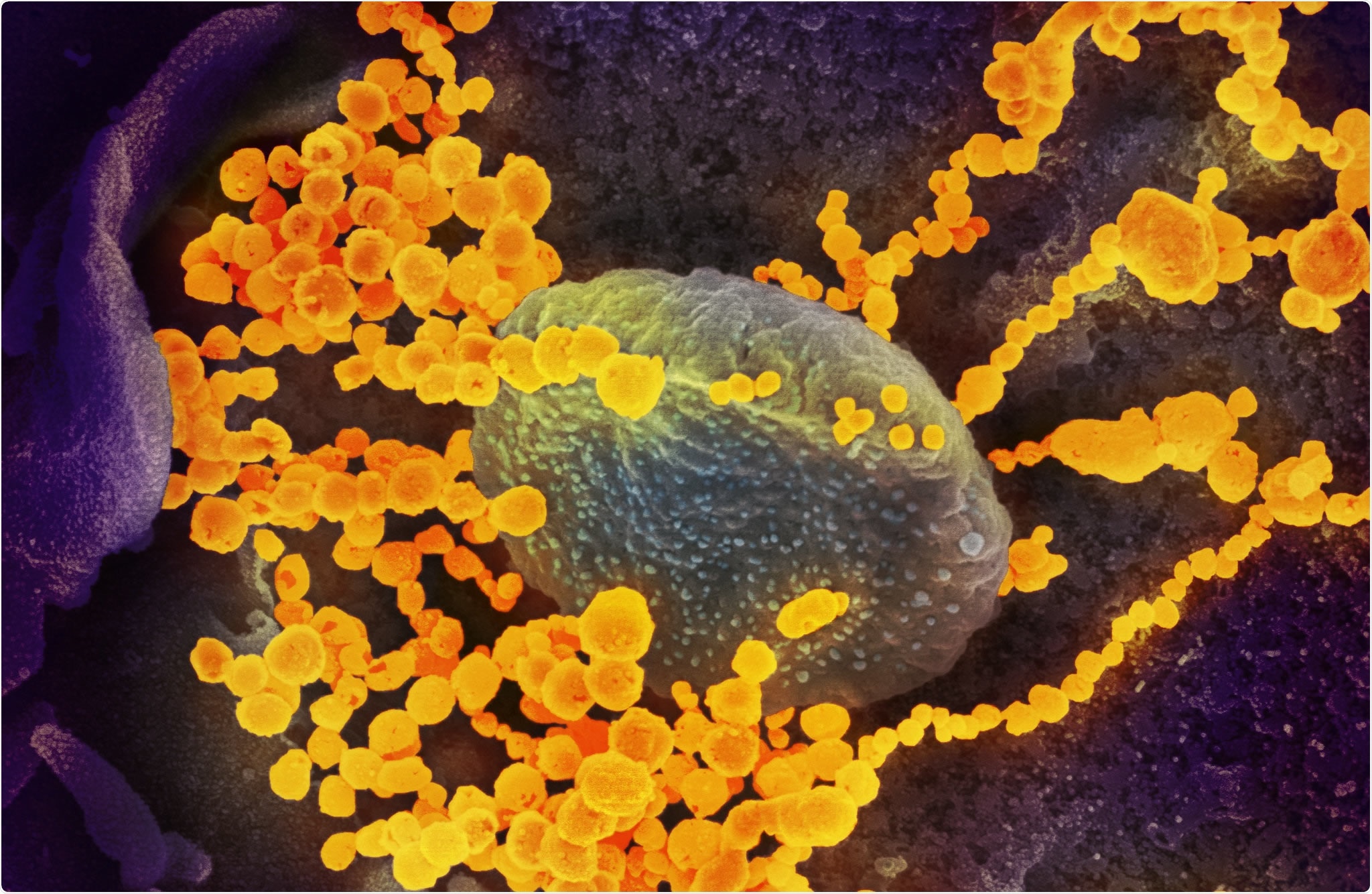 Study: SARS-CoV-2 invasion of the central nervous: a brief review. Image Credit: NIAID