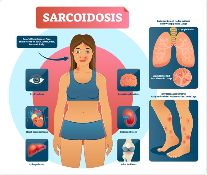 sarcoidosis