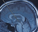 What Does Deep Brain Stimulation Involve?