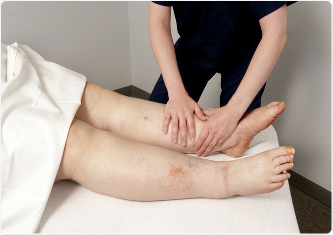 Lymphedema of the legs. Image Credit: futurewalk / Shutterstock