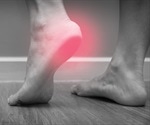 Plantar Fasciitis Symptoms and Diagnosis