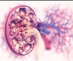 Chronic Kidney Disease Causes