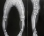Rickets Treatments