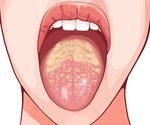 Oral Thrush (Candidiasis) Treatment