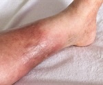 What is Cellulitis?