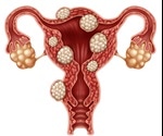 Uterine Fibroids Treatment